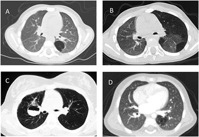 Congenital Lung Malformations: Unresolved Issues and Unanswered Questions